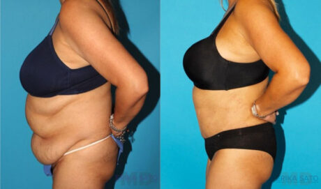 Tummy Tuck case #7170
