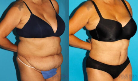 Tummy Tuck case #7170
