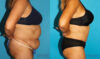 Tummy Tuck case #7170 slider thumbnail