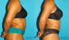 Liposuction case #5894 slider thumbnail