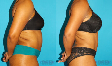 Liposuction case #5894