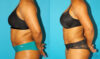 Liposuction case #5894 slider thumbnail