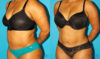 Liposuction case #5894 slider thumbnail