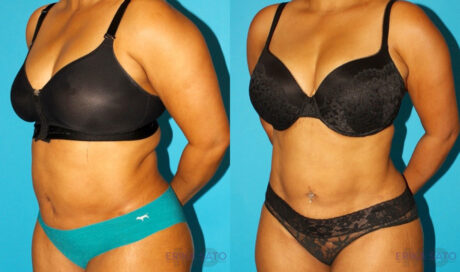 Liposuction case #5894