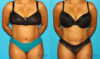 Liposuction case #5894 slider thumbnail