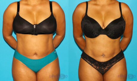Liposuction case #5894