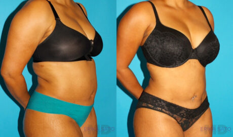 Liposuction case #5894
