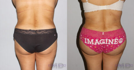 Brazilian Butt Lift case #4725