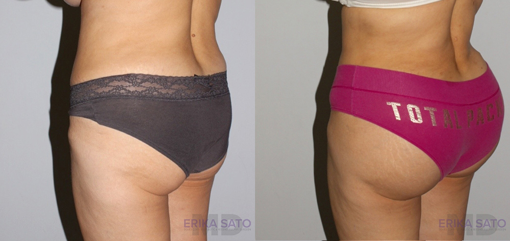 Brazilian Butt Lift case #4725