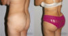 Brazilian Butt Lift case #4725 slider thumbnail
