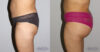 Brazilian Butt Lift case #4725 slider thumbnail