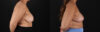 Breast Reduction case #8018 slider thumbnail