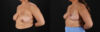 Breast Reduction case #8018 slider thumbnail