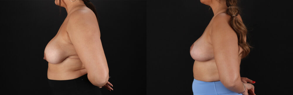 Breast Reduction case #8018