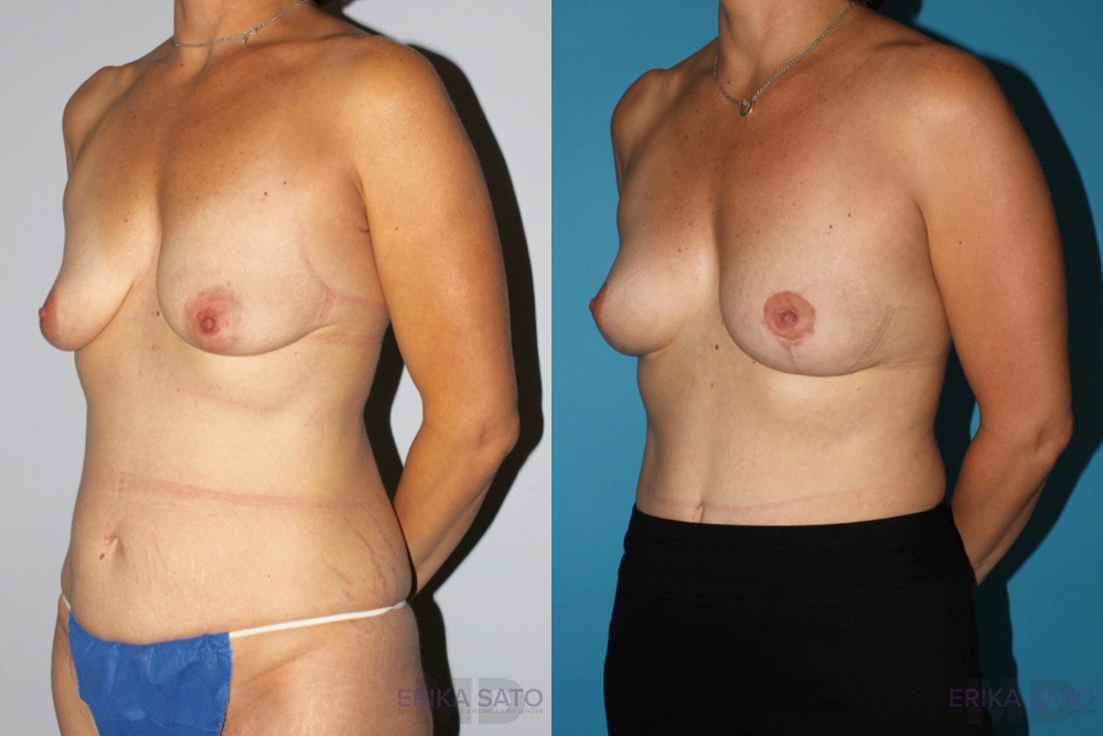 Breast Lift case #6939