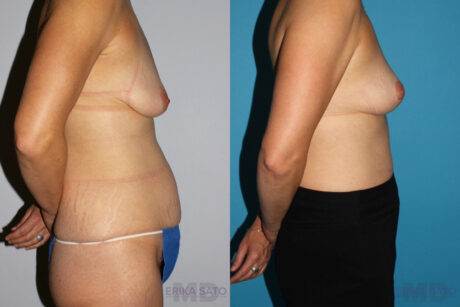 Breast Lift case #6939