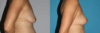 Breast Lift case #6939 slider thumbnail