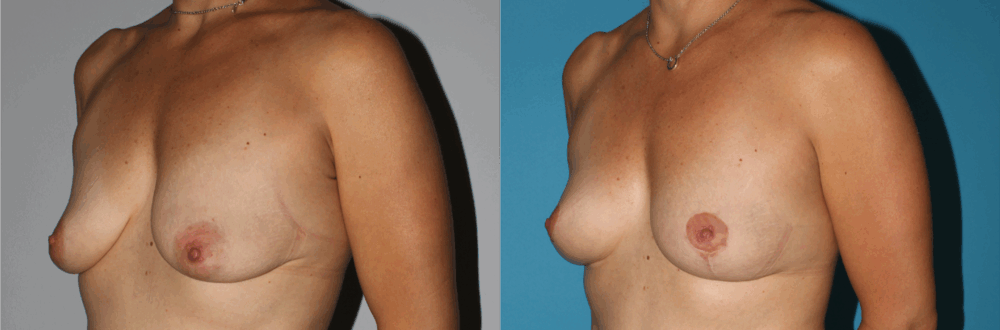 Breast Lift case #6939