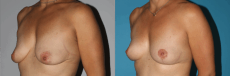 Breast Lift case #6939