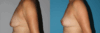 Breast Lift case #6939 slider thumbnail