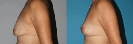 Breast Lift case #6939