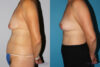 Breast Lift case #6939 slider thumbnail