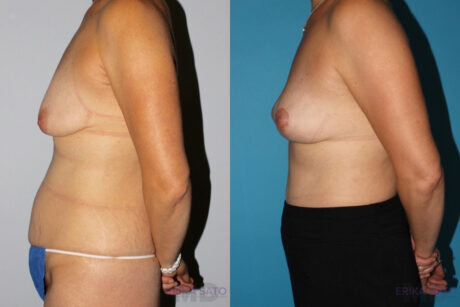 Breast Lift case #6939