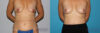 Breast Lift case #6939 slider thumbnail