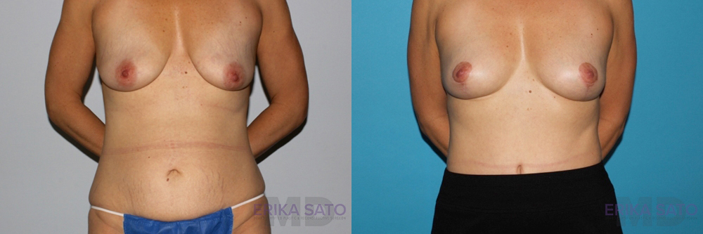Breast Lift case #6939
