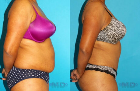 Tummy Tuck case #7279