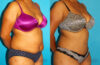 Tummy Tuck case #7279 slider thumbnail