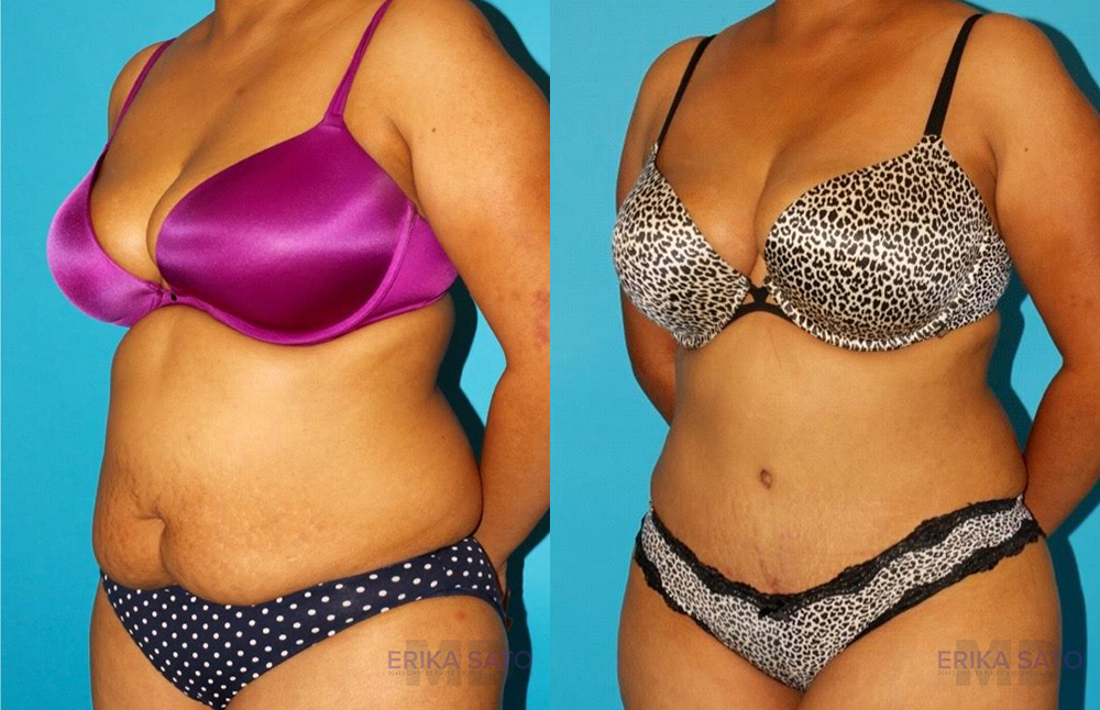 Tummy Tuck case #7279