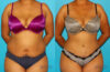 Tummy Tuck case #7279 slider thumbnail