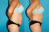 Tummy Tuck case #7278 slider thumbnail