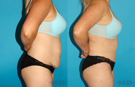 Tummy Tuck case #7278