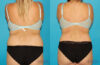 Tummy Tuck case #7278 slider thumbnail