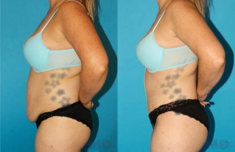 Tummy Tuck case #7278