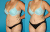 Tummy Tuck case #7278 slider thumbnail
