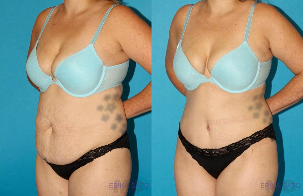Tummy Tuck case #7278