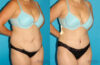 Tummy Tuck case #7278 slider thumbnail