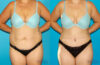 Tummy Tuck case #7278 slider thumbnail