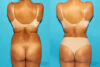 Brazilian Butt Lift case #4616 slider thumbnail