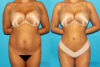 Brazilian Butt Lift case #4616 slider thumbnail