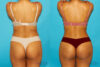Brazilian Butt Lift case #4767 slider thumbnail