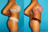 Brazilian Butt Lift case #4767 slider thumbnail
