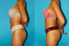 Brazilian Butt Lift case #4767 slider thumbnail