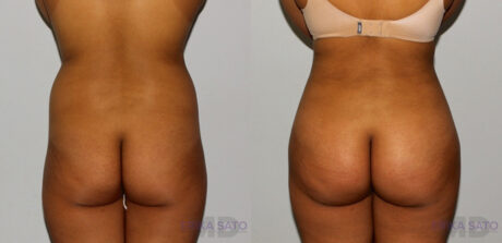 Brazilian Butt Lift case #4478