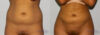 Brazilian Butt Lift case #4478 slider thumbnail