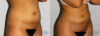 Brazilian Butt Lift case #4478 slider thumbnail