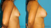 Breast Augmentation case #5632 slider thumbnail